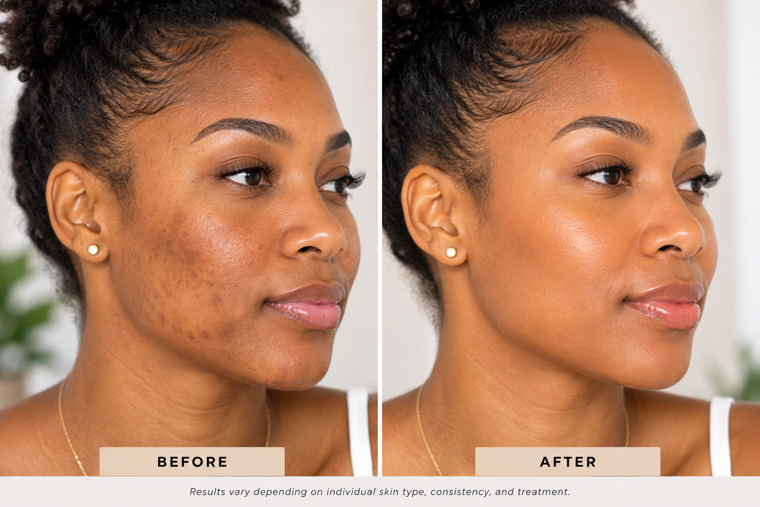 The Complete Guide to Hyperpigmentation: Causes, Prevention & Treatment